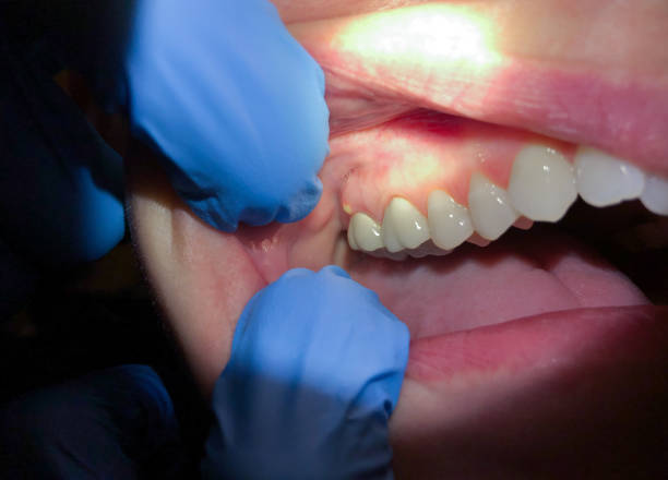 Best Emergency Denture Repair in Williamsburg, PA