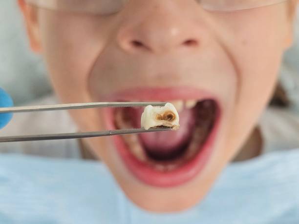 Best Emergency Treatment for Dental Infections or Abscesses in Williamsburg, PA
